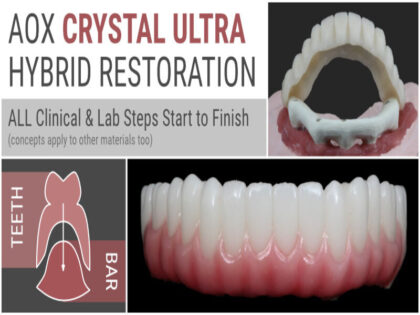 AOX Crystal Ultra Hybrid Restoration – ALL Clinical & Lab Steps Start to Finish